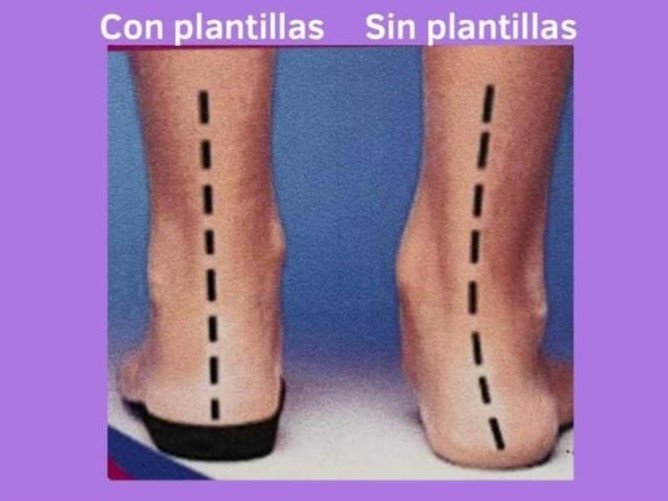 Corrección de pisada